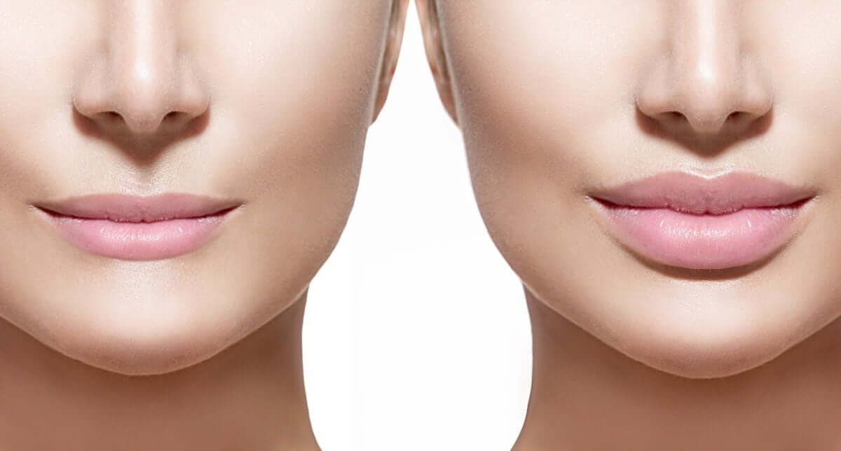 What to do after getting lip fillers